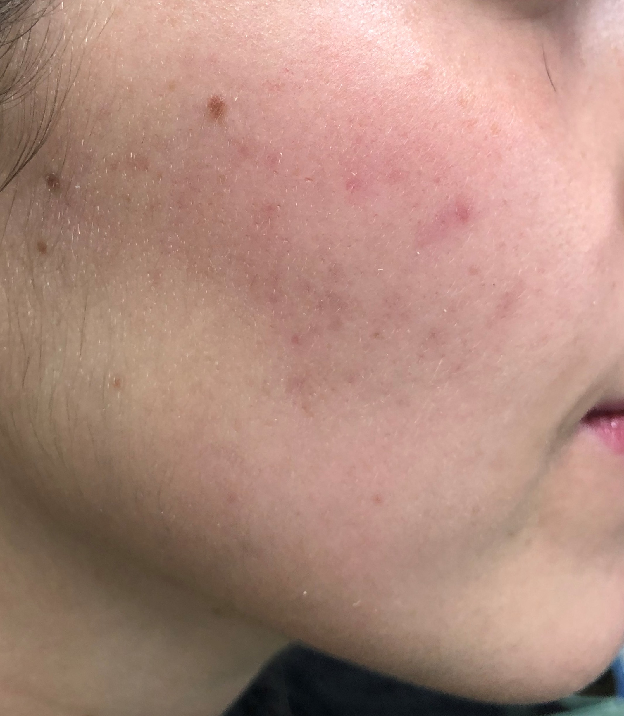 Casos de Acné - Antes y Después de Luz pulsada